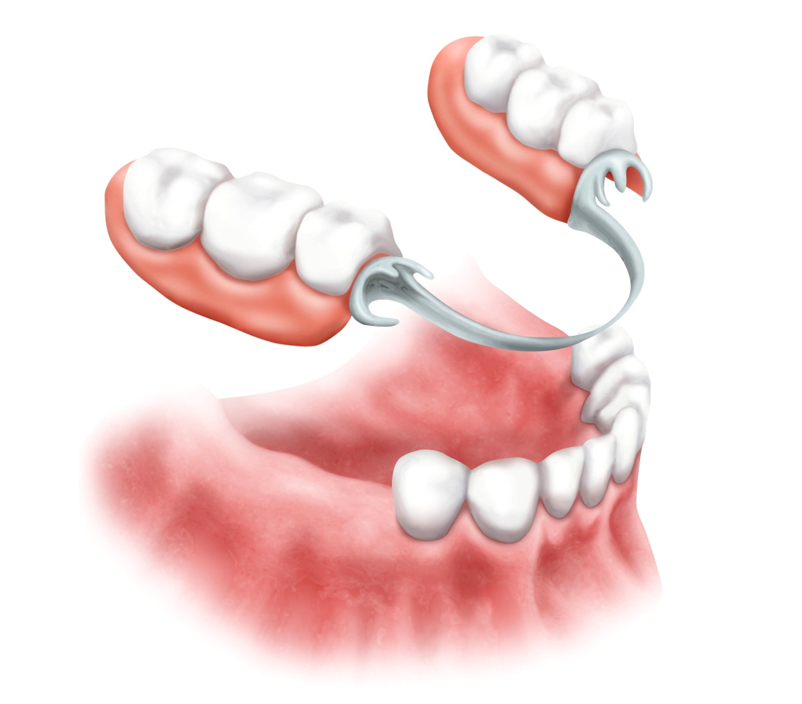 Съемное протезирование зубов - ООО «Центр Стоматологии 32 Практика»