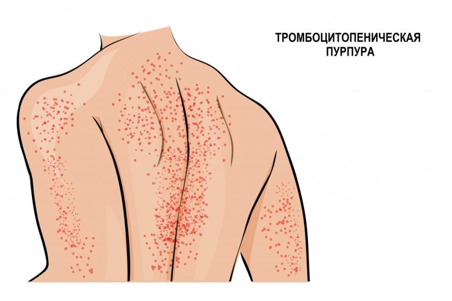 Тромбоцитопения - причины появления, при каких заболеваниях возникает,  диагностика и способы лечения