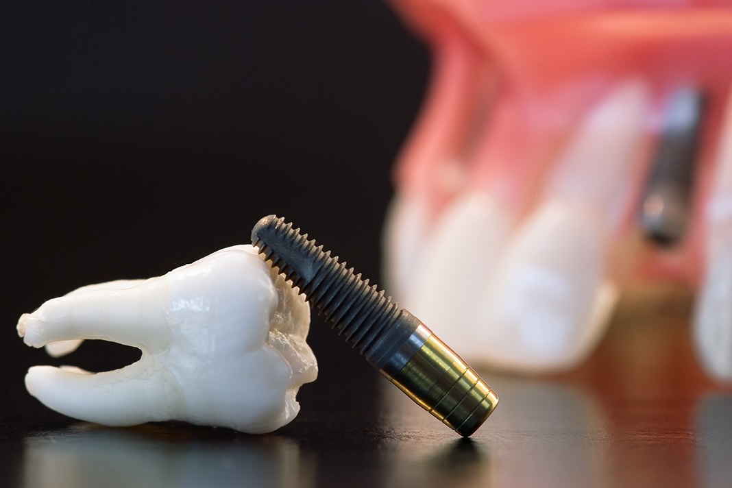 установка зубного импланта