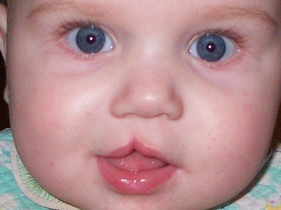 Заячья губа у детей: фото, причины, симптомы, лечение
